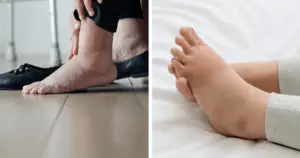 Swollen ankles