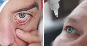 Dry eyes