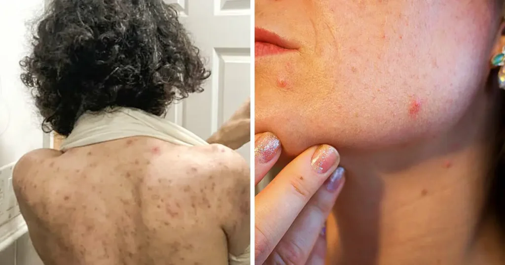 Why Acne Appears on These 8 Body Areas, and What You Should Do
